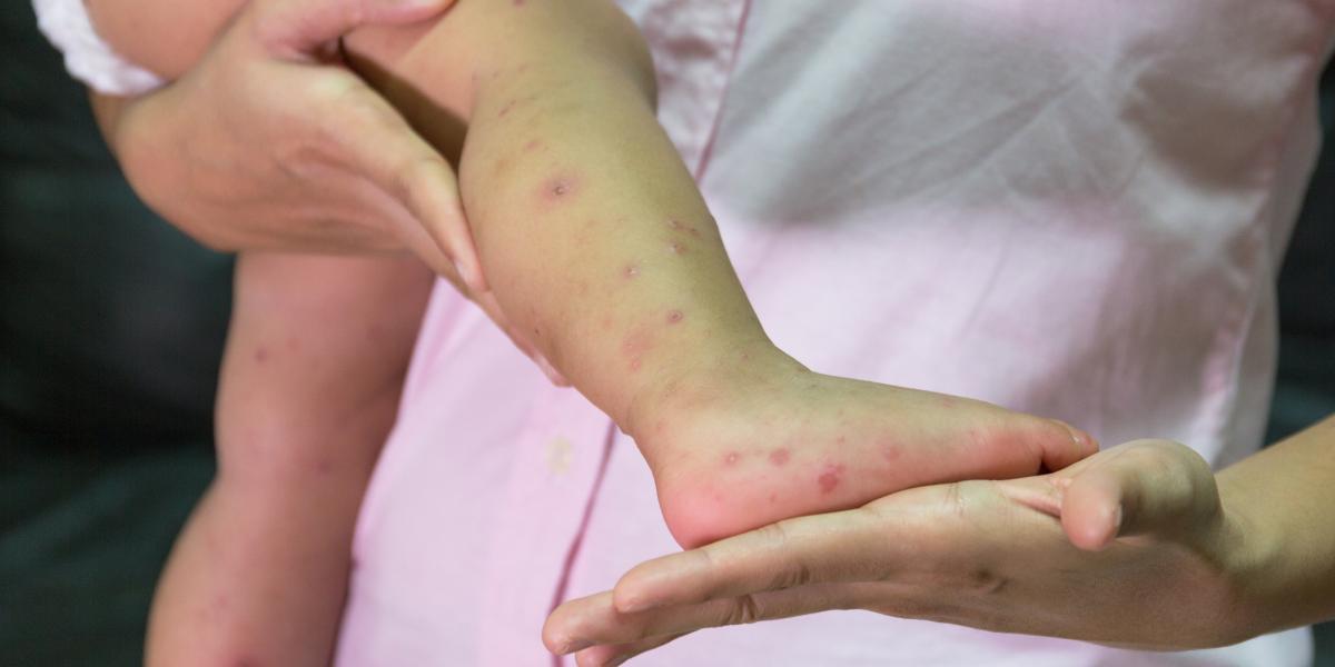 banner of The Facts About Hand Foot and Mouth Disease