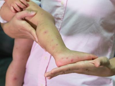 thumbnail of The Facts About Hand Foot and Mouth Disease