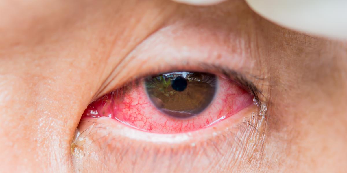 banner of What Causes People to Suffer From Pink Eye? 
