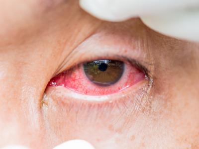 thumbnail of What Causes People to Suffer From Pink Eye? 