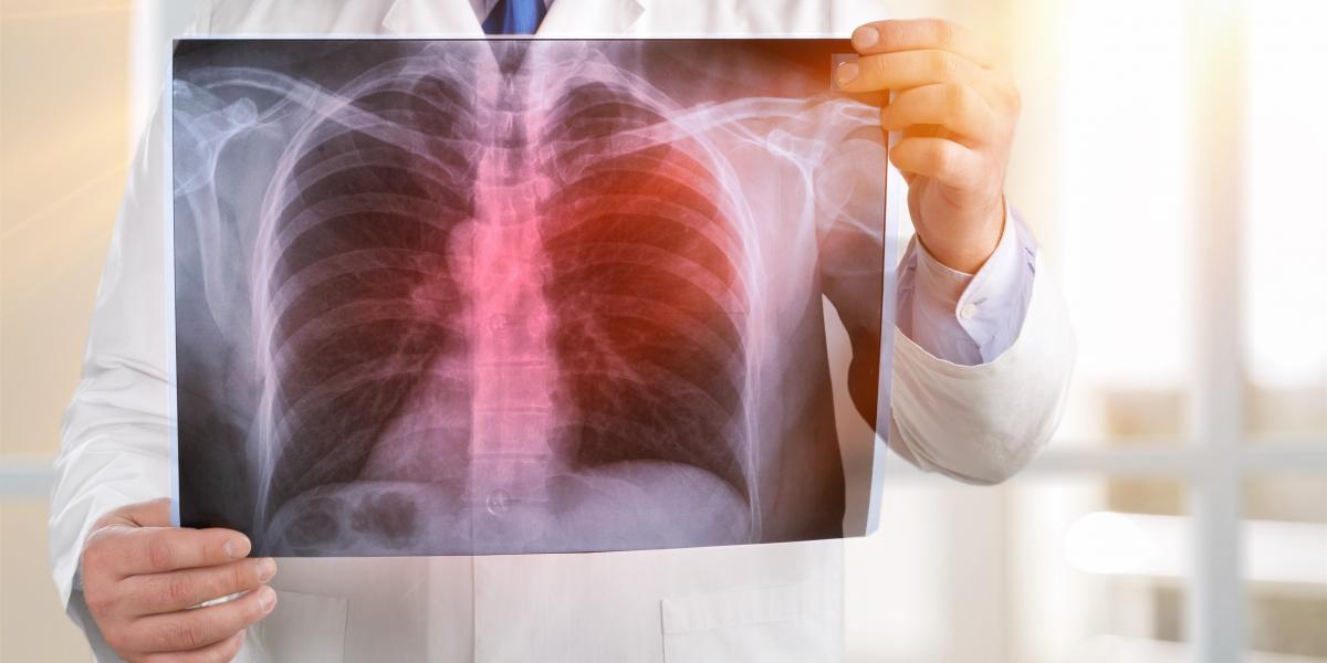 banner of Is it Tuberculosis? You Should Know the Signs 